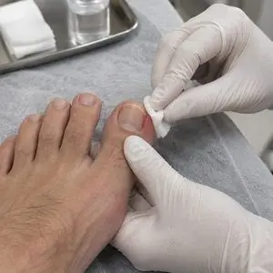 Tratamento de unha infeccionada na Aos Pés Podologia